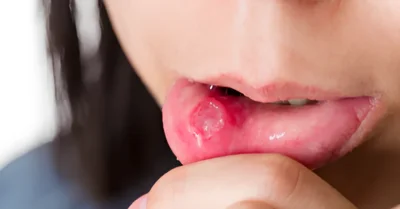 5 Penyebab Sariawan di Bibir yang Harus Kamu Tahu