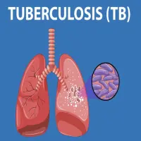 Jawa Barat Catat 81.864 Kasus Tuberkulosis dalam Lima Bulan, Pemerintah Perkuat Penemuan Kasus