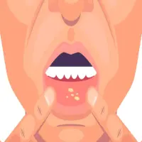 Cara Mengobati Sariawan di Bibir, Efektif Sembuh dengan Cepat