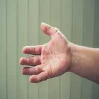 Jangan Sepelekan! Ini Faktor Penyebab Campak yang Membuat Penularan Semakin Meluas