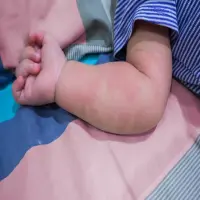 Ratusan Kasus Campak Ditemukan di Subang, Dinkes Gencarkan Imunisasi Anak