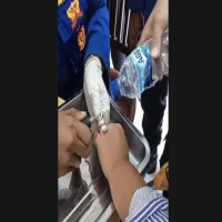 Cincin dari Pacar Susah Lepas dan Bikin Jari Bengkak, Perempuan di Subang Minta Bantuan Damkar