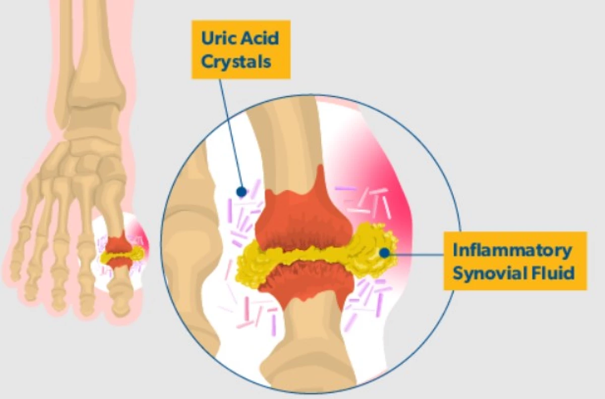 Penyebab Asam Urat di Usia Muda. (Sumber Ilustrasi: arthritis.ca)